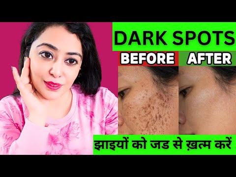 नारियल तेल में बस 1 चीज़ मिलने से झाइयों को जड़ से ख़त्म करें Pigmentation Removal