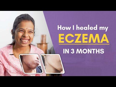 How I Healed My Eczema In Just 3 Months