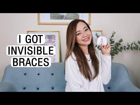 My toothsi Invisible Aligners Experience